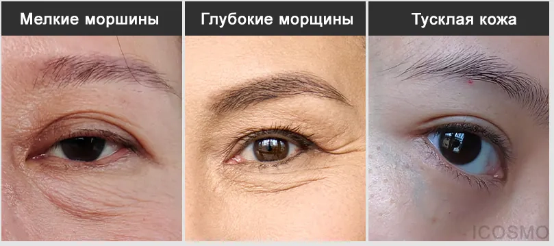 Для какой кожи нужны гидрогелевые патчи Medi Peel Red Lacto Collagen Eye Patch