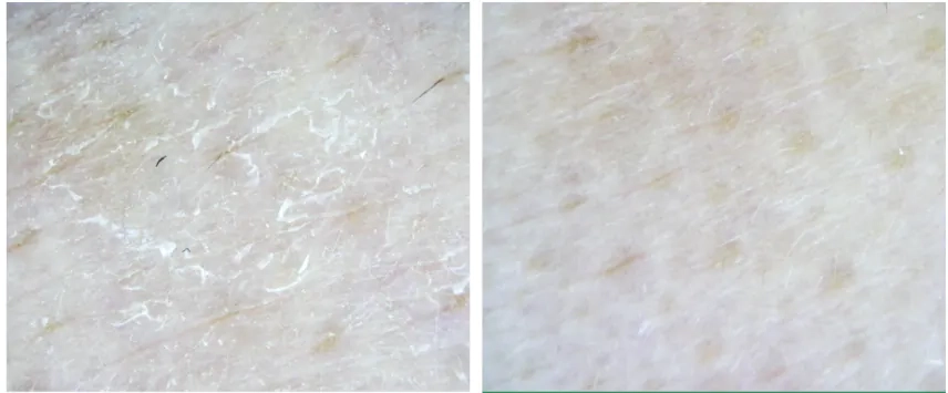 Удаление омертвевших клеток пилингом AXIS-Y PHA Resurfacing Glow Peel