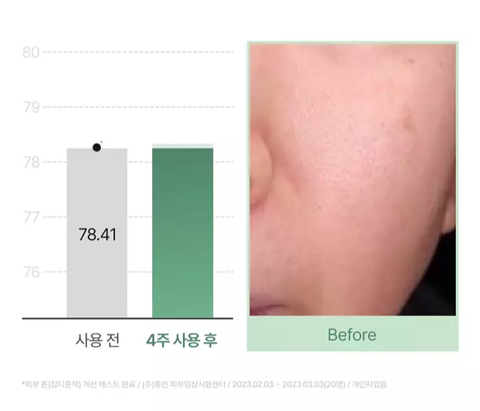 Покращення стану шкіри після сироватки Celimax Cica Niacinamide AC Calming Serum