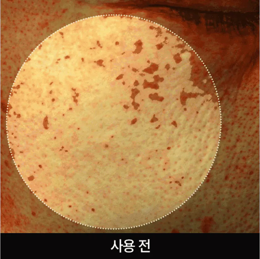 Осветление пигментации после крема APOTHE Exosome Mela-Glu Brightening Cream