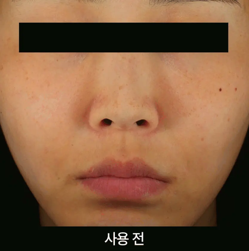 Уменьшение тусклости кожи после крема APOTHE Exosome Mela-Glu Brightening Cream