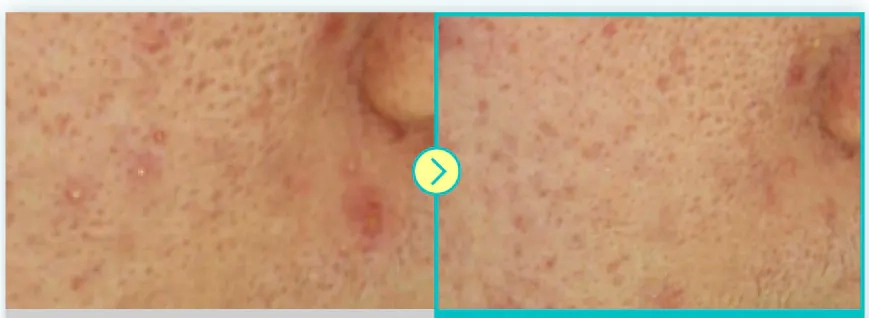 Зменшення жирності шкіри після крему NUMBUZIN No.1 Pantothenic B5 Active Soothing Cream