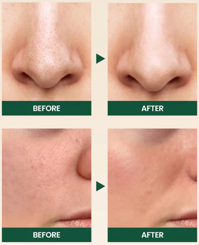 Результаты использования пенки для умывания K-Secret Seoul 1988 Cleansing Foam Pine Cica 1% + Probiotics