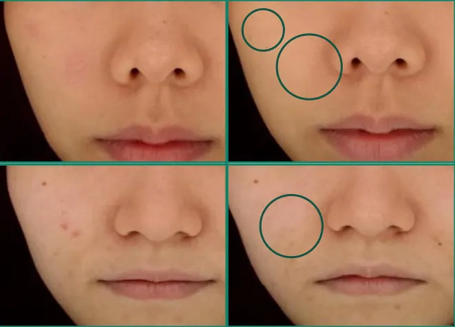 Результаты после продукта Medi peel A.C.Tea Clear