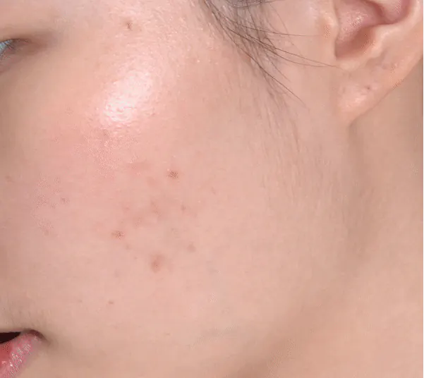 Точечное средство от прыщей Medi peel A.C.Tea Clear