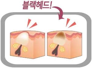 Шаг 1 патчей Enough 3 Step Blackhead Clear Solution