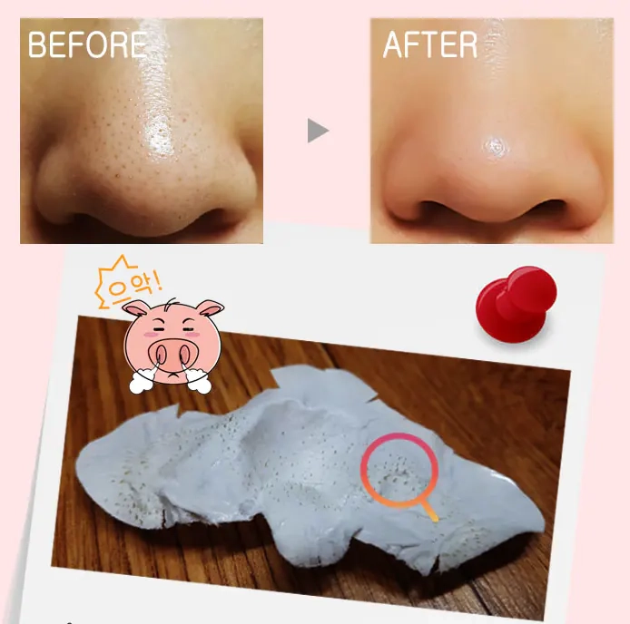 Результаты использования патчей для носа Enough 3 Step Blackhead Clear Solution