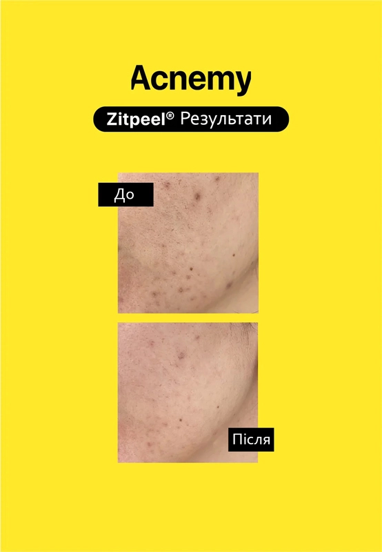 Мультикислотный пилинг для кожи склонной к акне - Acnemy Zitpeel, 40 мл - фото N3