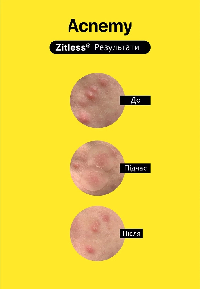 Пластир з мікроголками проти прищів на ранніх стадіях - Acnemy Zitless, 5 шт - фото N4