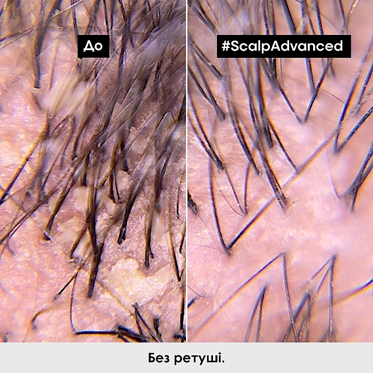 L'Oreal Professionnel Профессиональный дерморегулирующий шампунь против перхоти Scalp Advanced Anti Dandruff Shampoo - фото N6